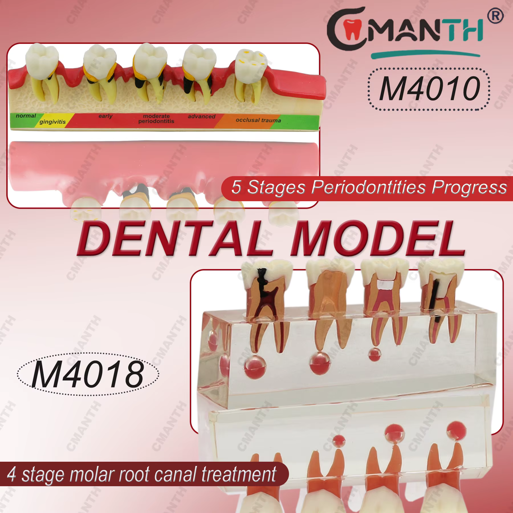 Modèle dentaire de traitement endodontique en 4 étapes et de maladie parodontale en 5 étapes pour la communication et la démonstration entre dentiste et patient