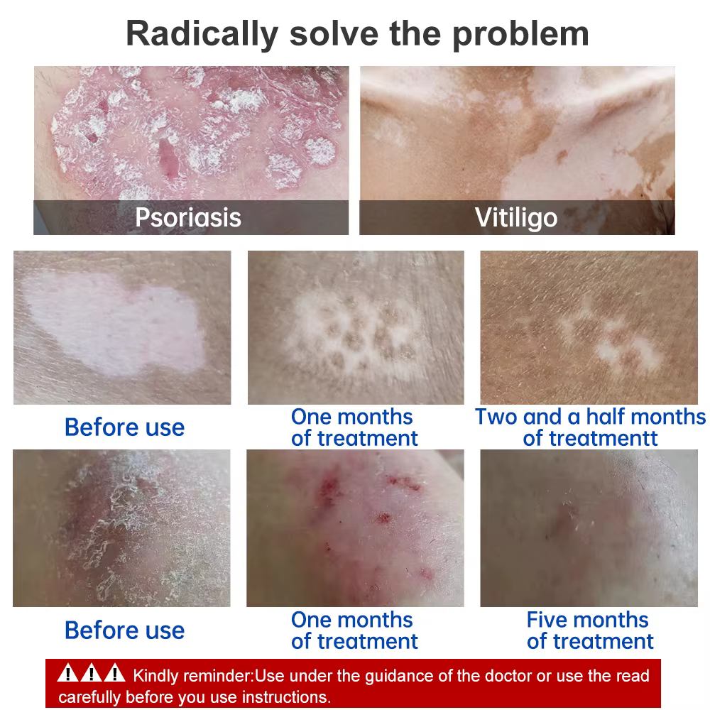 YouWetemporal-Lumière de Photothérapie Uremboursable, Lampe de Traitement du Vitiligo et du Psoriasis, Thérapie UV à Bande Étroite, avec Minuterie, 311nm