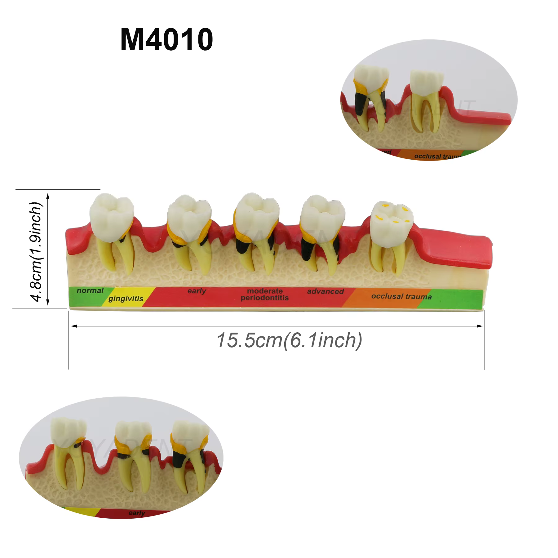 Modèle dentaire de traitement endodontique en 4 étapes et de maladie parodontale en 5 étapes pour la communication et la démonstration entre dentiste et patient