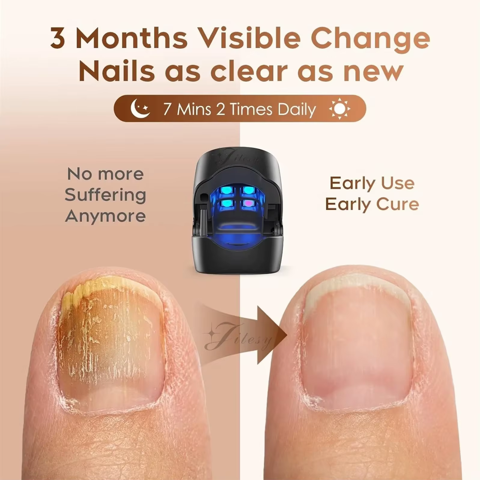 Appareil laser LED pour le traitement des mycoses des ongles, nettoyage de l'onychomycose, charge USB, lumière infrarouge 905 nm, lumière bleue 470 nm, salon de manucure