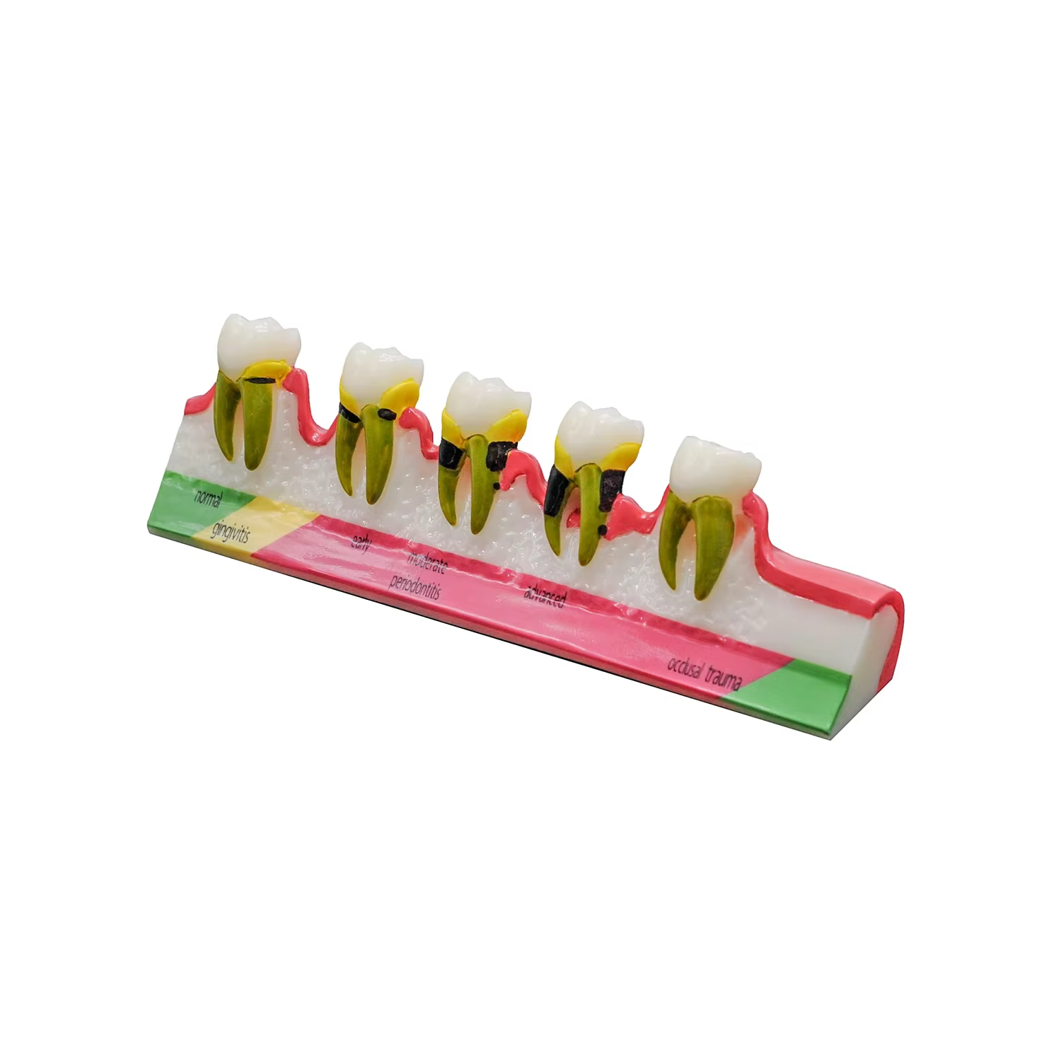 1PC étude dentaire modèle d'enseignement maladies parodontales assortiment dents Dentoform Typodont pour les étudiants dentistes étudiant enseignement
