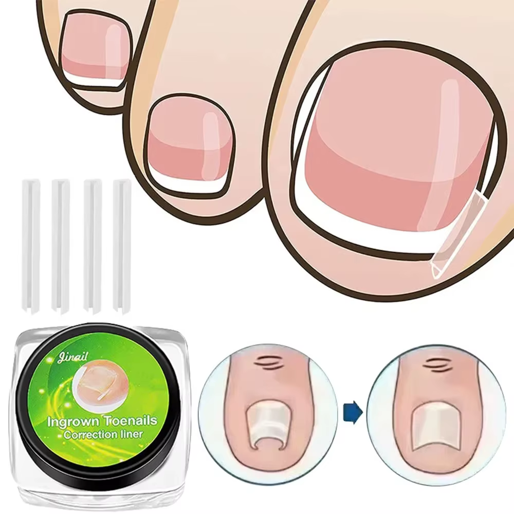 Outil de Correction des ongles incarnés, traitement des ongles incarnés, Patch élastique autocollant, Clip de redressage, attelle, outil de pédicure, 10 pièces