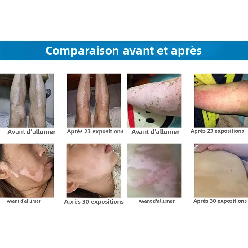 Prix d'usine, laser excimer UVB LED 311 Nm, photothérapie, laser excimer pour le traitement du psoriasis, lampe UVB 311 Nm pour le traitement du vitiligo