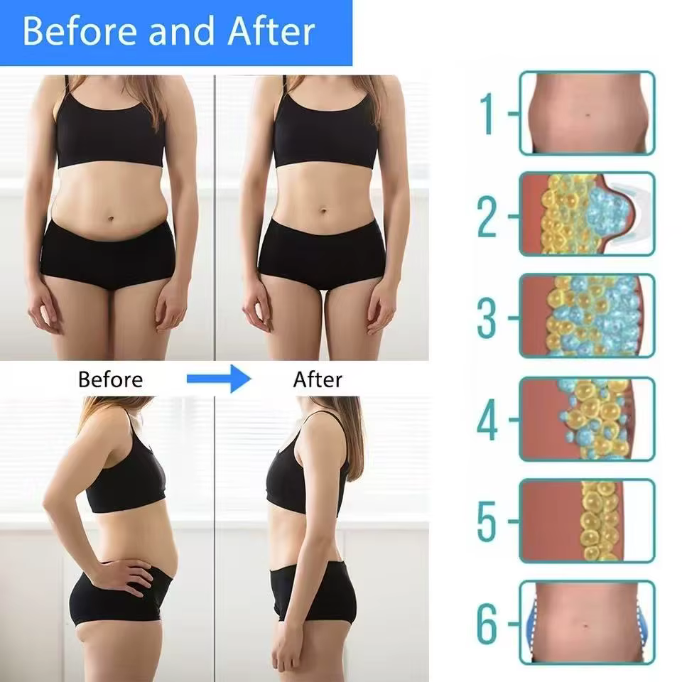 Cryothérapie pour dissoudre la graisse, thérapie par le froid, masseur anti-cellulite, machine de lipolyse abdominale, élimination de la graisse, amincissement du corps