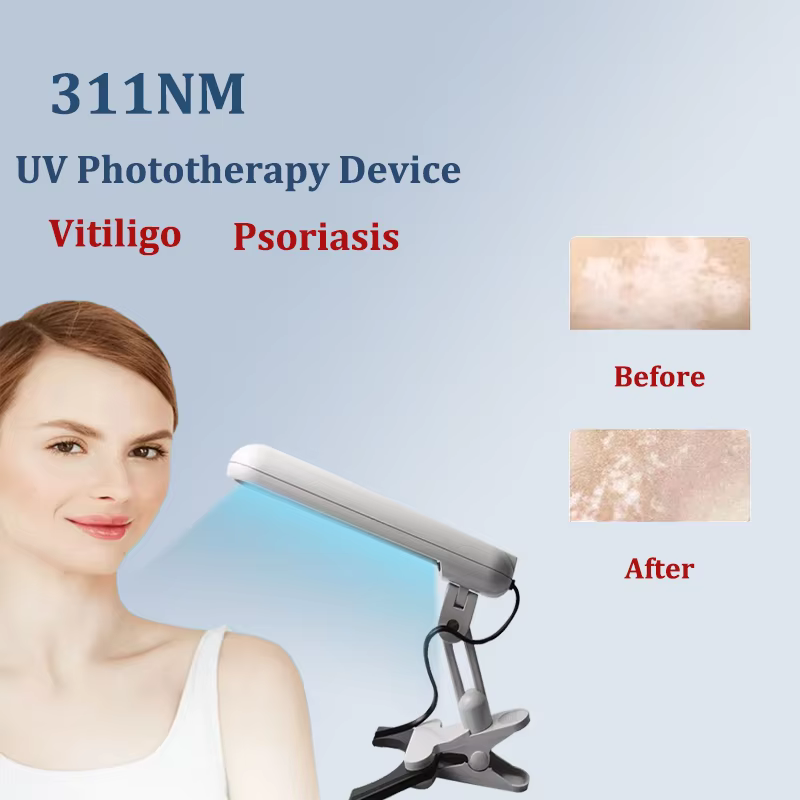 Lampe de photothérapie UVB 311nm, dispositif pour le traitement du Vitiligo, thérapie à la lumière ultraviolette UV à bande étroite, taches de Psoriasis, eczéma