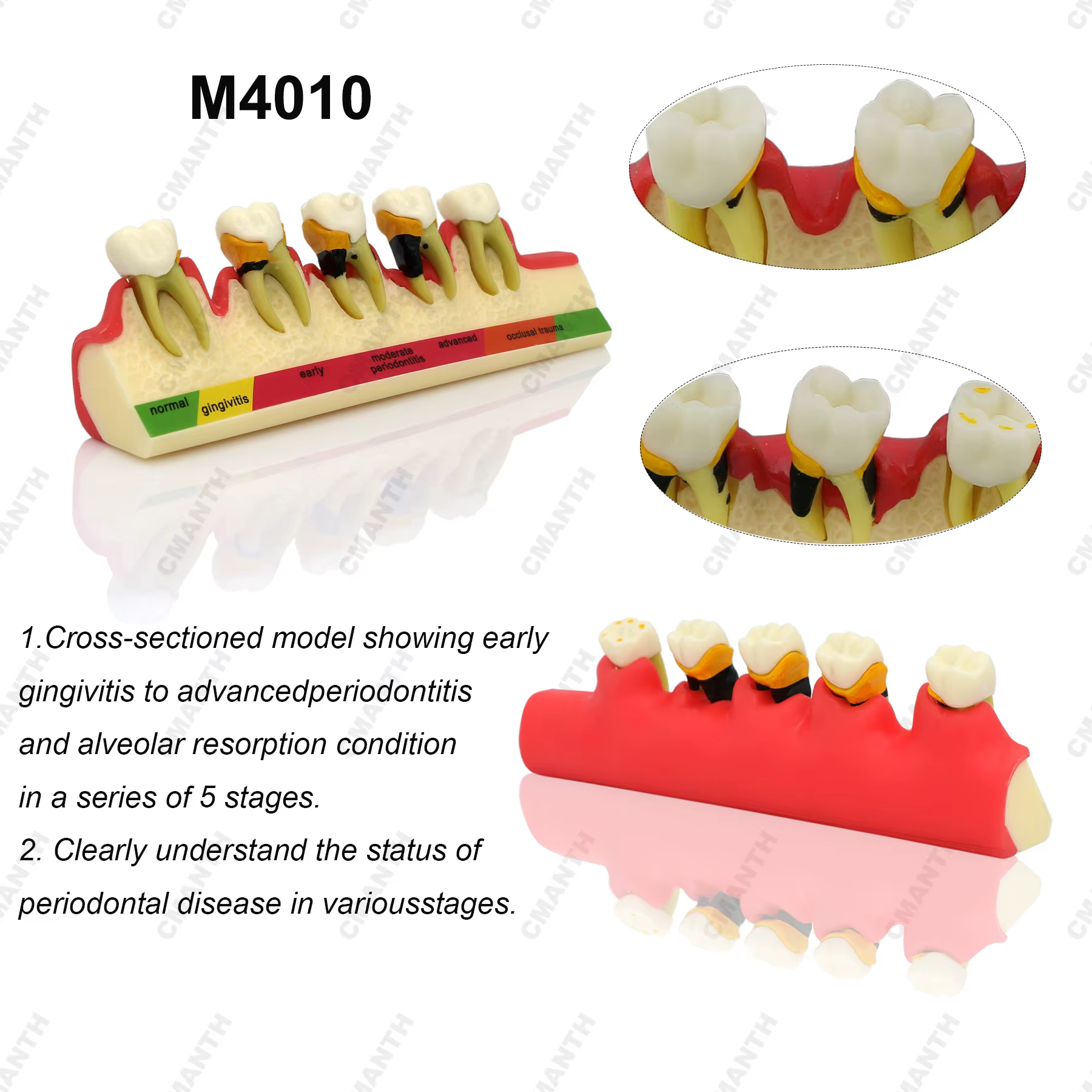 Modèle dentaire de traitement endodontique en 4 étapes et de maladie parodontale en 5 étapes pour la communication et la démonstration entre dentiste et patient