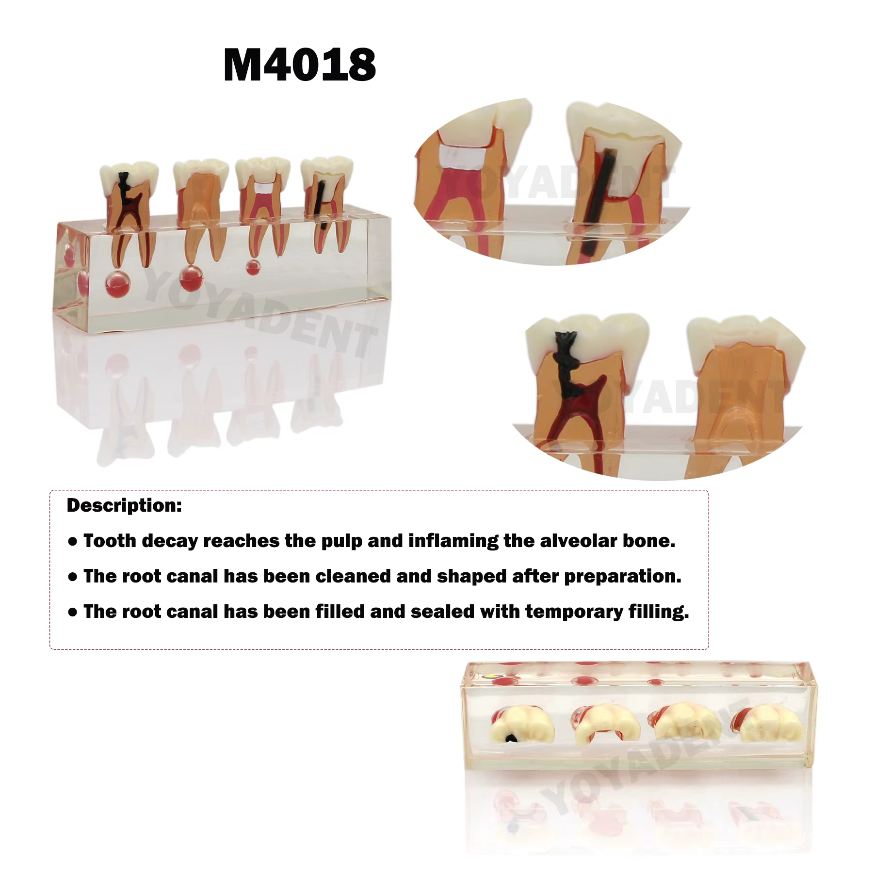 Modèle dentaire de traitement endodontique en 4 étapes et de maladie parodontale en 5 étapes pour la communication et la démonstration entre dentiste et patient