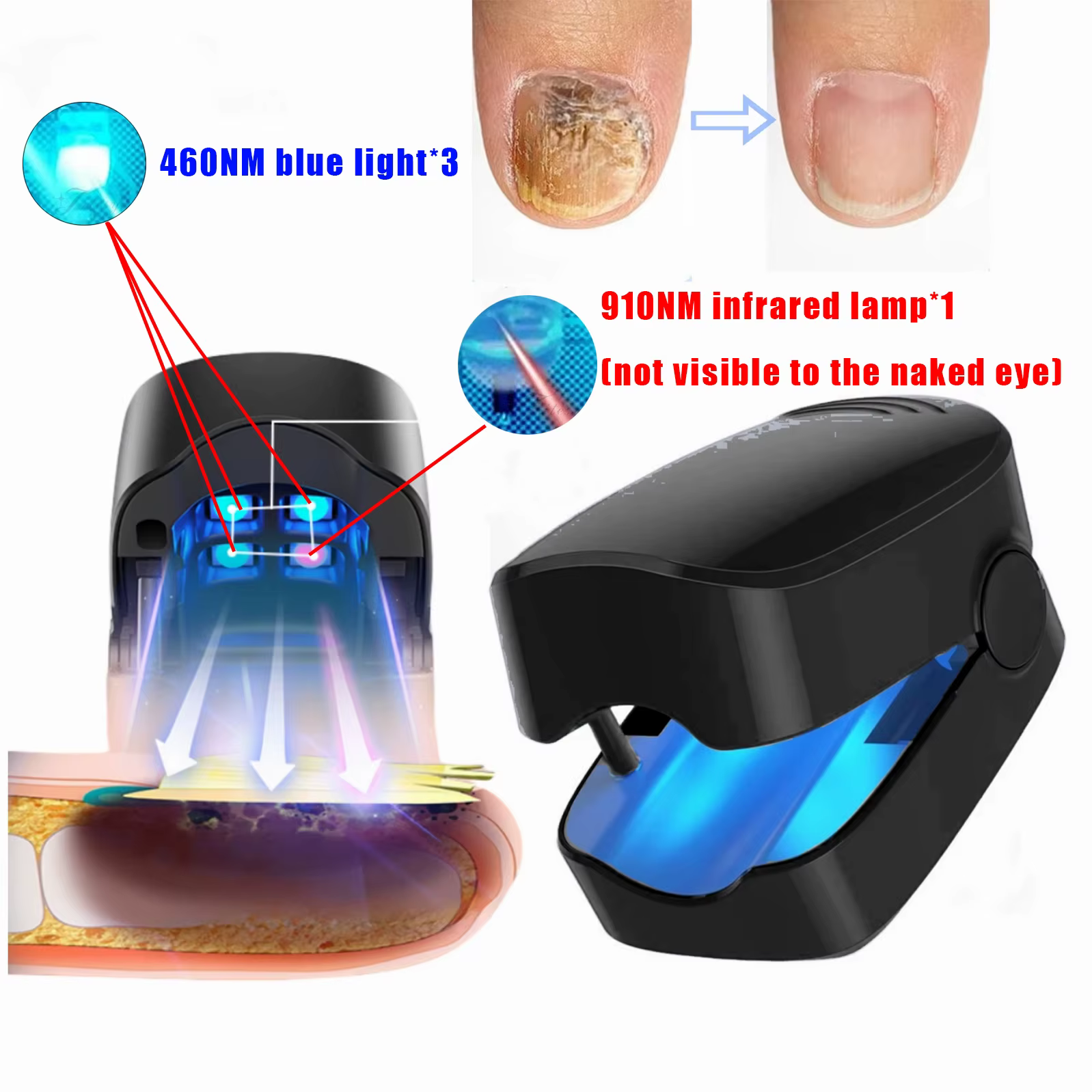 Appareil laser LED pour le traitement des mycoses des ongles, nettoyage de l'onychomycose, charge USB, lumière infrarouge 905 nm, lumière bleue 470 nm, salon de manucure