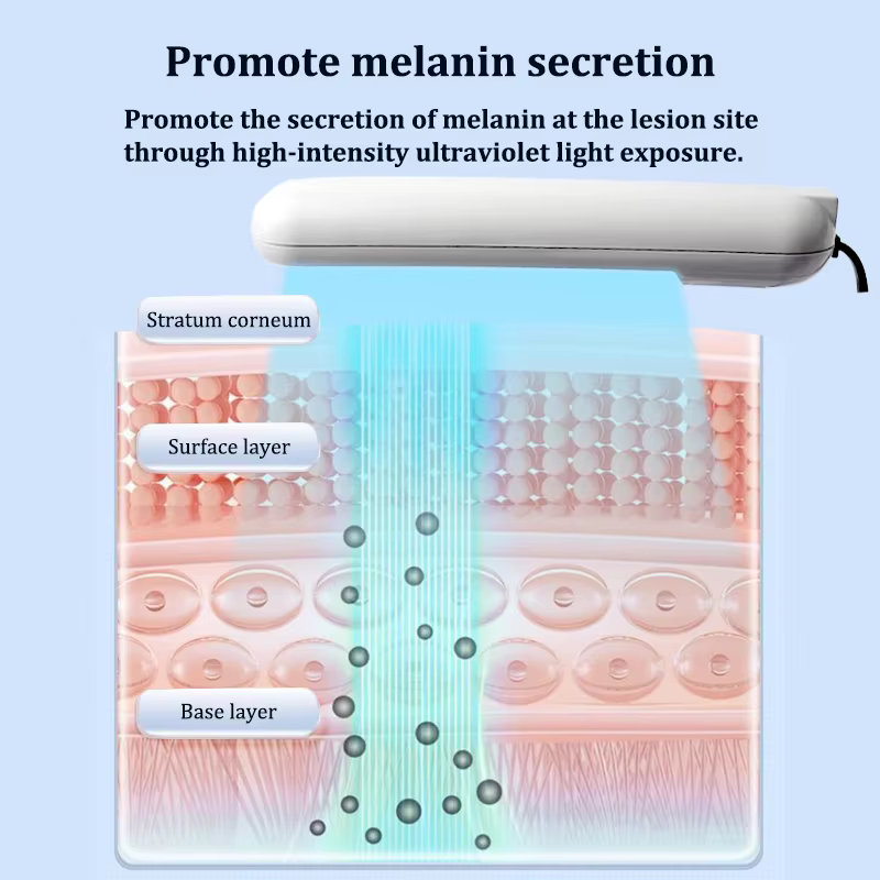 Lampe de photothérapie UVB 311nm, dispositif pour le traitement du Vitiligo, thérapie à la lumière ultraviolette UV à bande étroite, taches de Psoriasis, eczéma