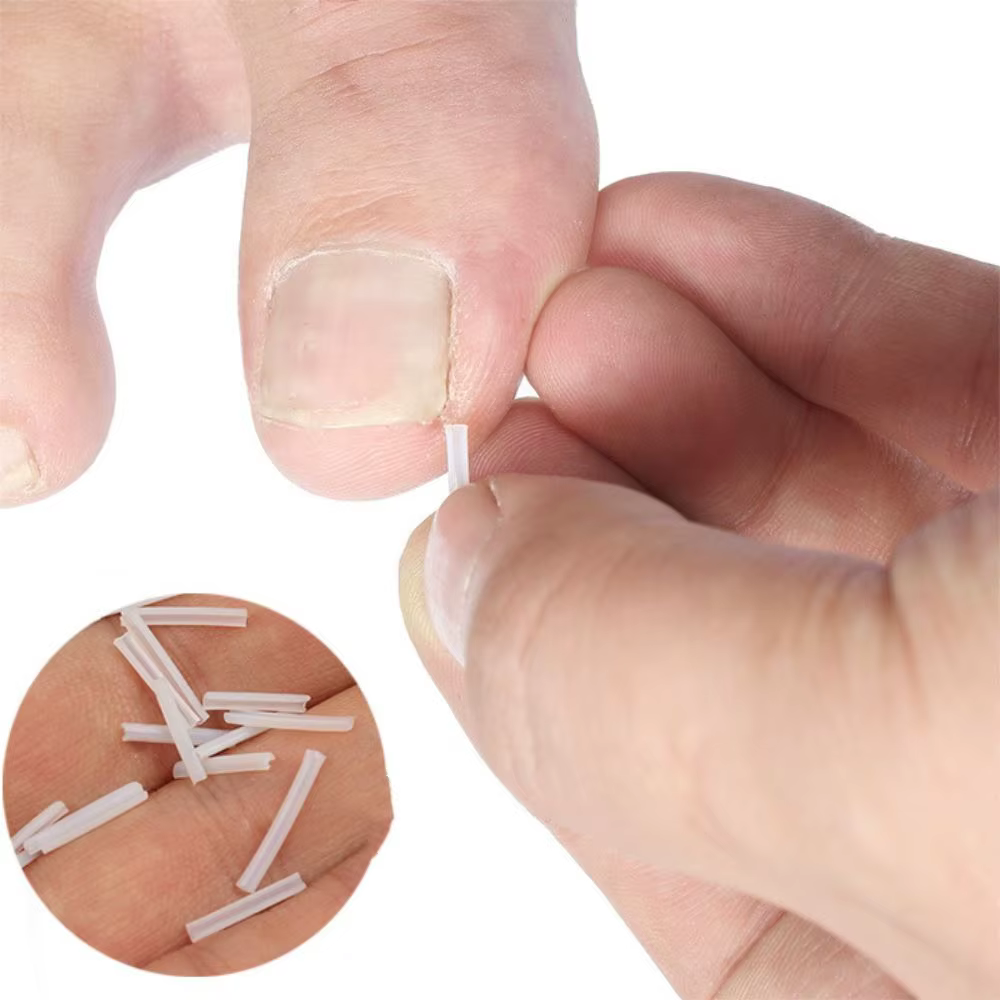 Outil de Correction des ongles incarnés, traitement des ongles incarnés, Patch élastique autocollant, Clip de redressage, attelle, outil de pédicure, 10 pièces
