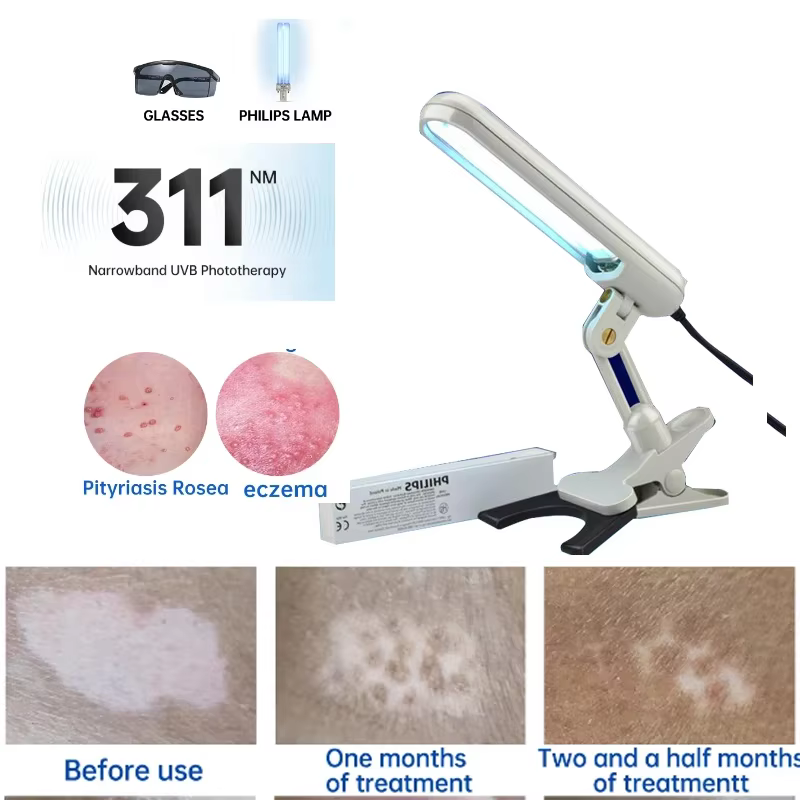 Lampe thérapeutique domestique non remboursable pour traitement du psoriasis et du vitiligo