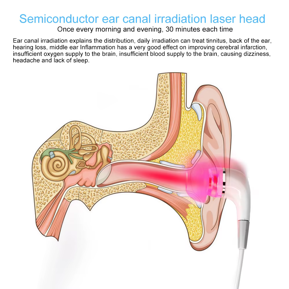 Thérapie laser auriculaire LLLT, irradiation laser, traitement physique du acouphènes, bouchons auriculaires, otite moyenne, surdité, rhinite nasale, sinusite