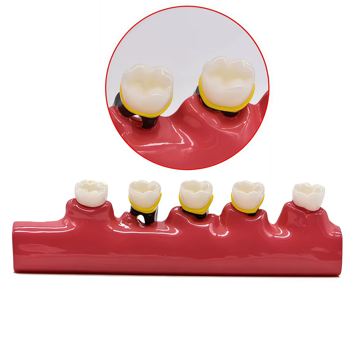 1PC étude dentaire modèle d'enseignement maladies parodontales assortiment dents Dentoform Typodont pour les étudiants dentistes étudiant enseignement