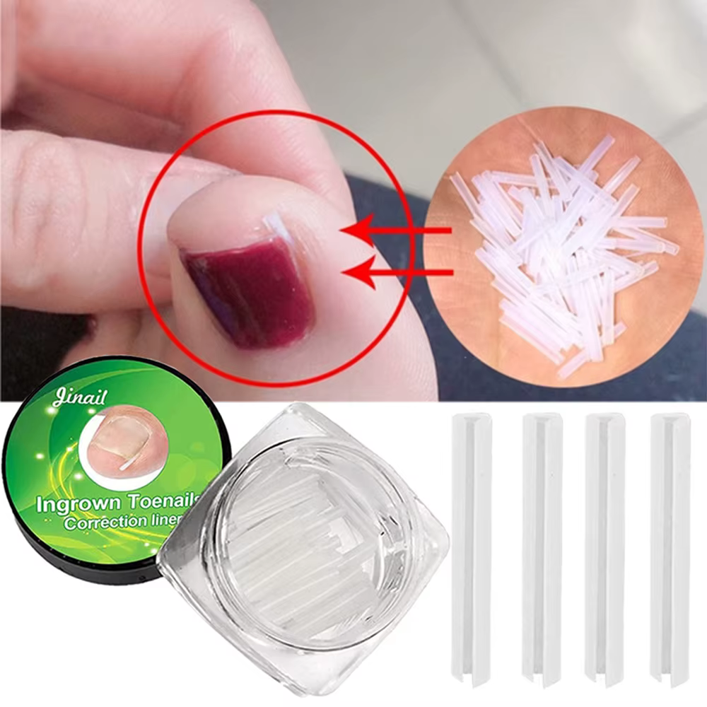 Outil de Correction des ongles incarnés, traitement des ongles incarnés, Patch élastique autocollant, Clip de redressage, attelle, outil de pédicure, 10 pièces